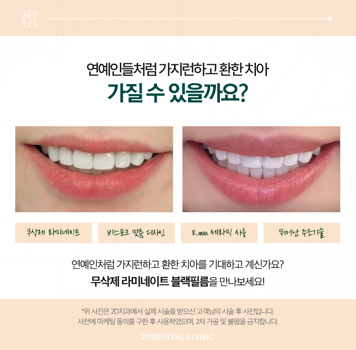 소중한 자연치 손상 없는 치아무삭제라미네이트 블랙필름 관련 이미지 3