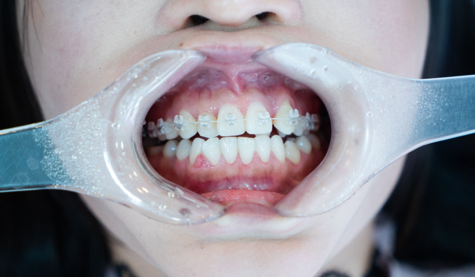 무삭제 라미네이트 교정 고민중이라면? 관련 이미지 1