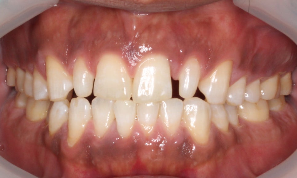 2D(투디)치과 블링스, 추천합니다!(깨진 앞니, 돌출앞니, 벌어진 앞니, 치아 노후, 치아 변색) 관련 이미지 6