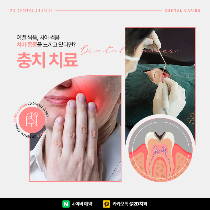 이빨썩음, 치아썩음 치과충치치료는 어떻게 할까? 선릉역치과에서 관련 이미지 1
