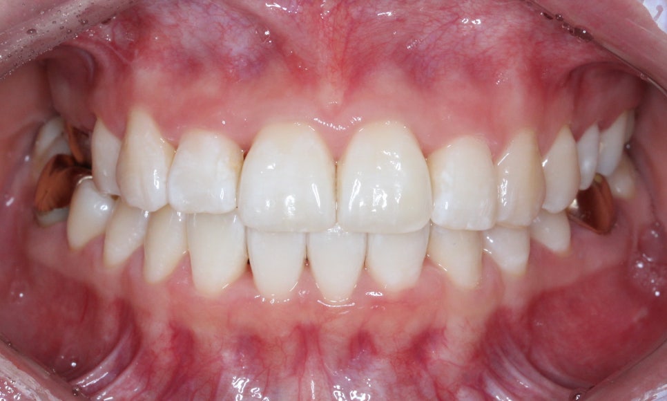 덧니 투명교정 8개월 치료 사례 관련 이미지 12