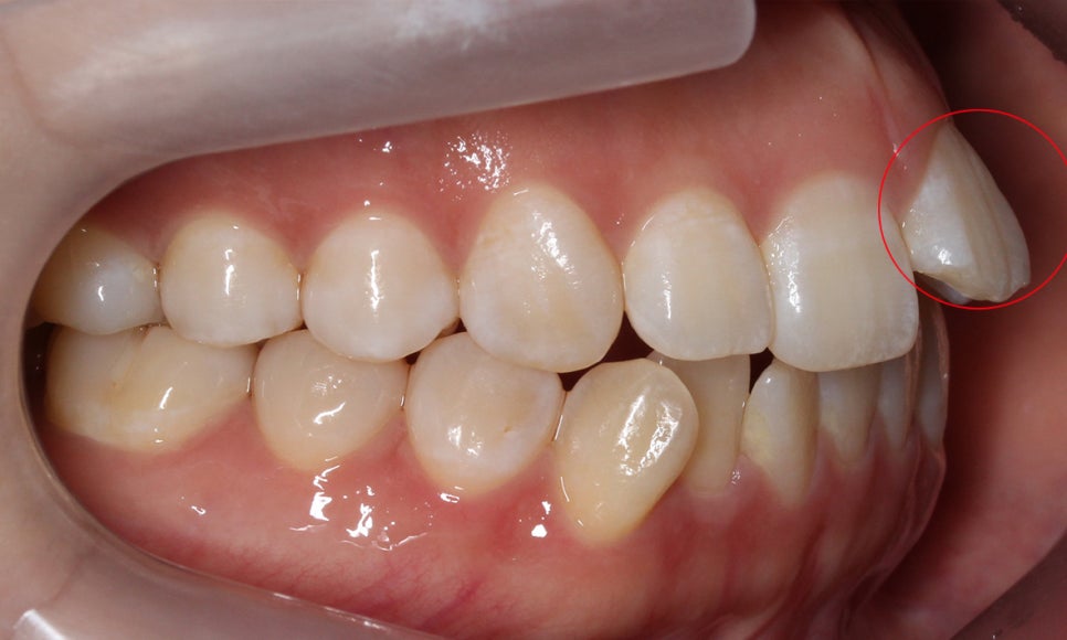 앞니돌출 급속교정 Case feat. 2D교정 관련 이미지 4