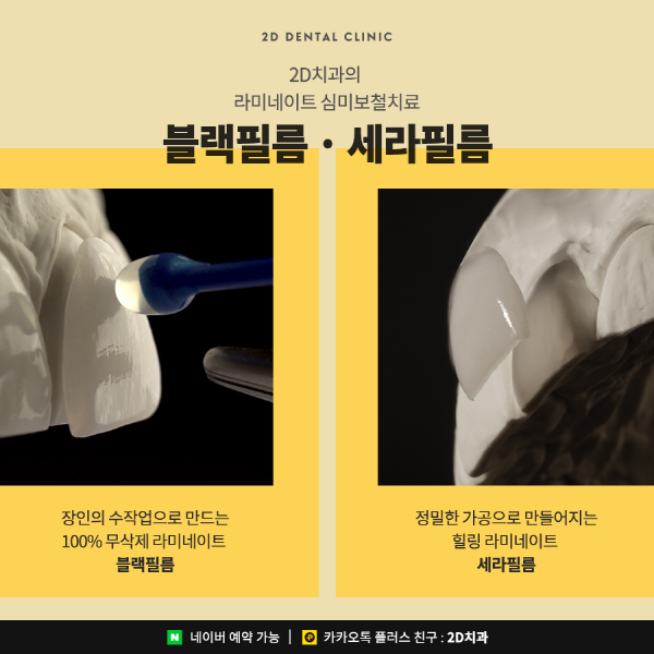 앞니깨짐, 치아변색 앞니고민 해결사! <세라필름 &middot; 블랙필름> 관련 이미지 6