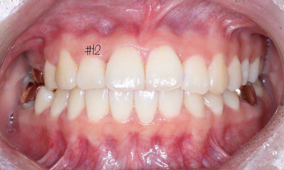 덧니 투명교정 8개월 치료 사례 관련 이미지 9