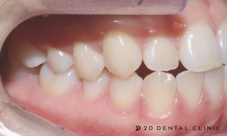 절단교합 교정 케이스 전후비교, 교정전문 2D치과 관련 이미지 16