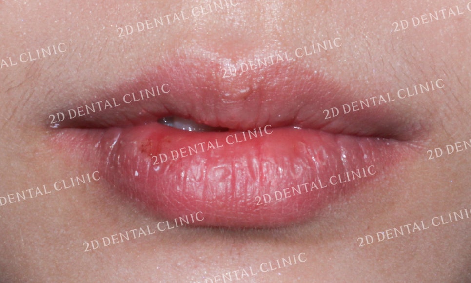 [투디교정] 덧니치아교정, 부분교정으로 쉽고 빠르게! by.투디치과(2D치과) 관련 이미지 8