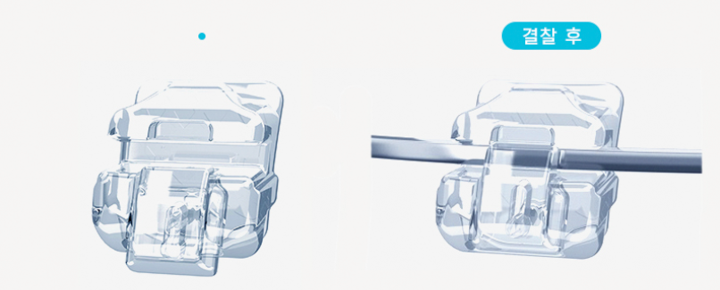 [투디(2D)치과] 데이먼 클리어 교정에 대해 알아보자! 관련 이미지 6