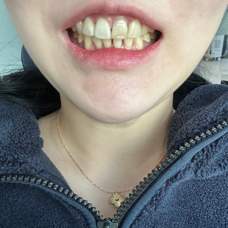 무삭제 라미네이트 개인의 치아디자인에 맞춘 단 하나밖에 없는 치아디자인 블랙필름 관련 이미지 8