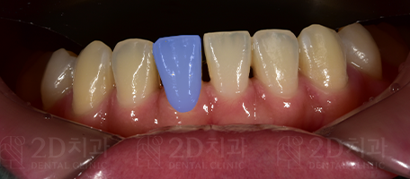 치아 블랙트라이앵글 원인, 예방, 치료 무삭제라미네이트 관련 이미지 3