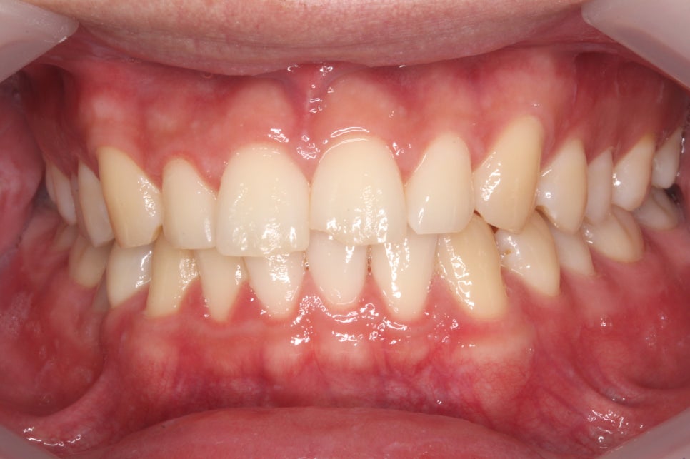 2D(투디)치과 블링스, 추천합니다!(깨진 앞니, 돌출앞니, 벌어진 앞니, 치아 노후, 치아 변색) 관련 이미지 8