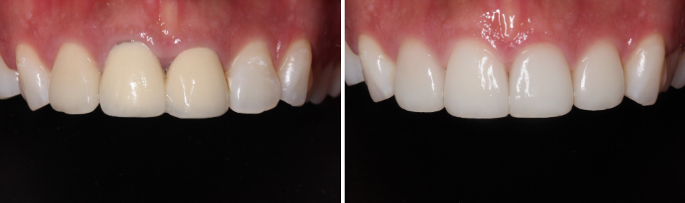 무삭제블랙필름 실제 후기 관련 이미지 14