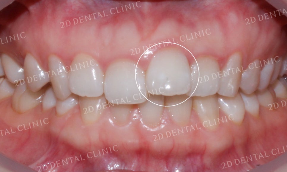 [투디교정] 덧니교정, 앞니교정으로 치열을 고르게! by.투디치과(2D치과) 관련 이미지 5