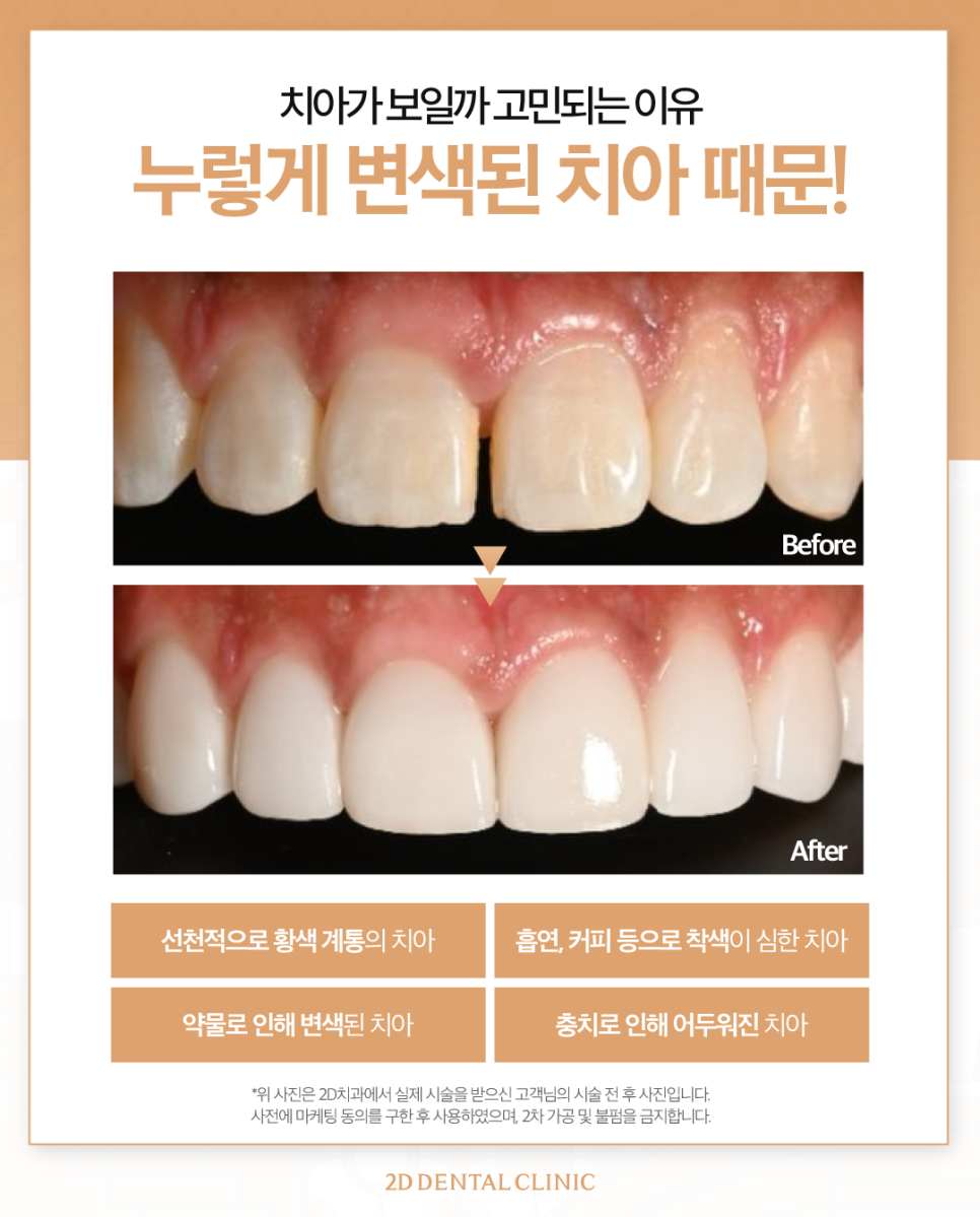 무삭제라미네이트 치아변색 블랙필름으로 화사해진 이 관련 이미지 3