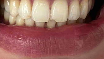 무삭제라미네이트 블랙필름의 장점과 사후관리 관련 이미지 9