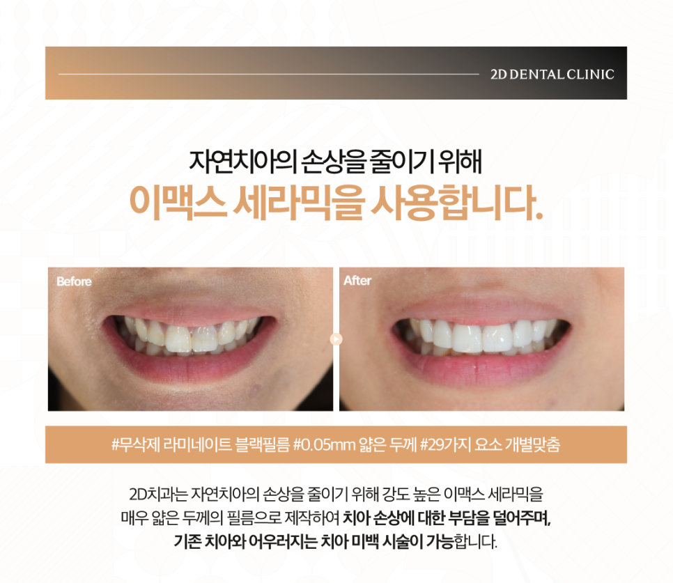 창원무삭제라미네이트 치과치아미백 어떤 방법이 좋을지 고민될 때 관련 이미지 5