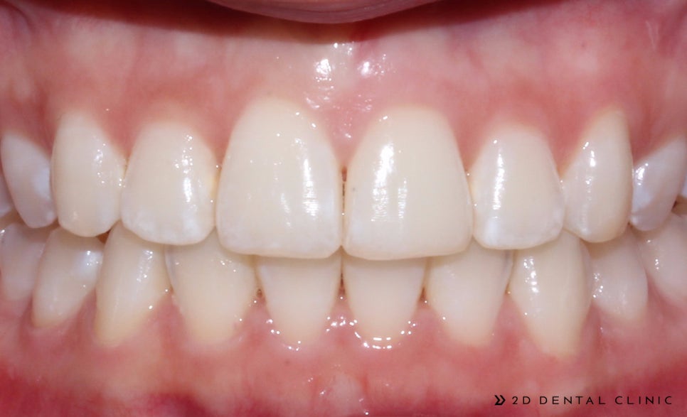 앞니 덧니 부분교정 케이스 전후비교, 교정전문 2D치과 관련 이미지 6