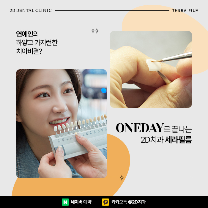 강남 연예인치아성형 환한 미소 부럽다면 원데이 세라필름 관련 이미지 2