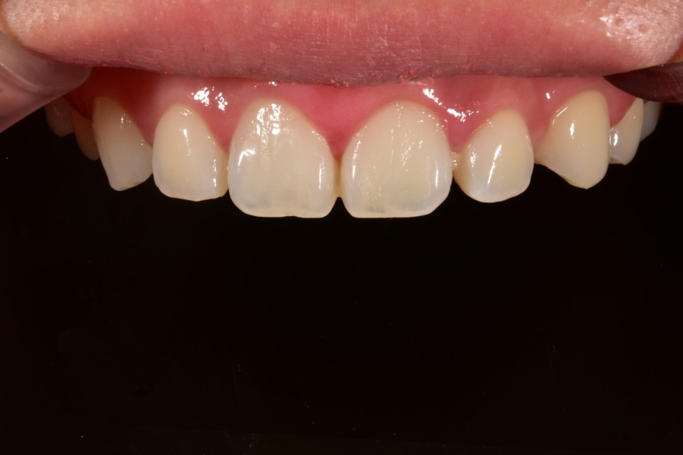 [투디치과] 블랙필름(비스포크) 치료의 다양한 사례 관련 이미지 21