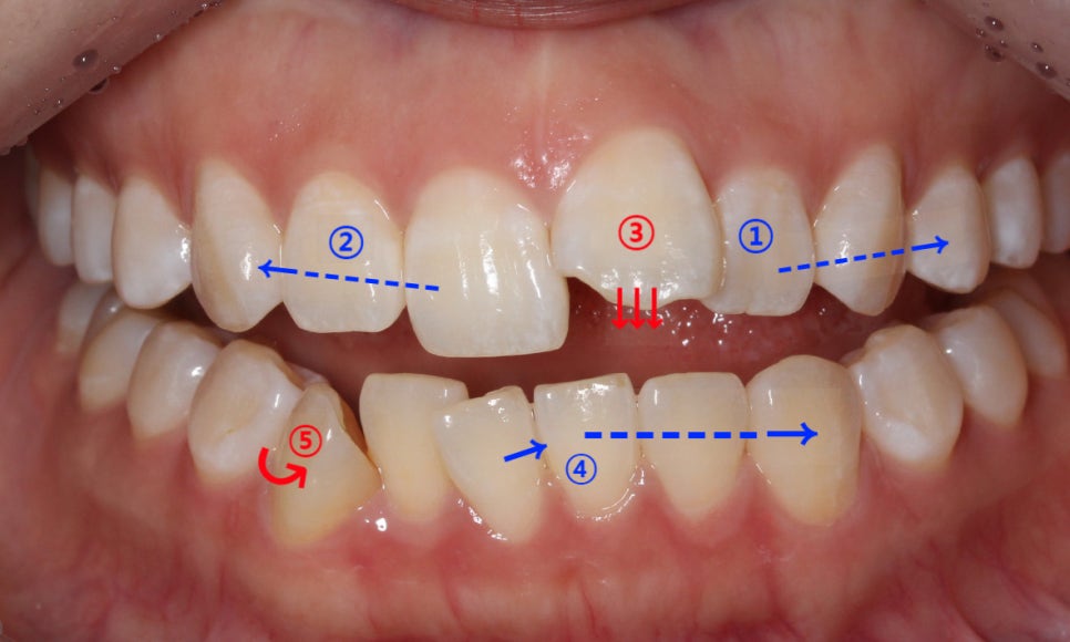 앞니돌출 급속교정 Case feat. 2D교정 관련 이미지 2