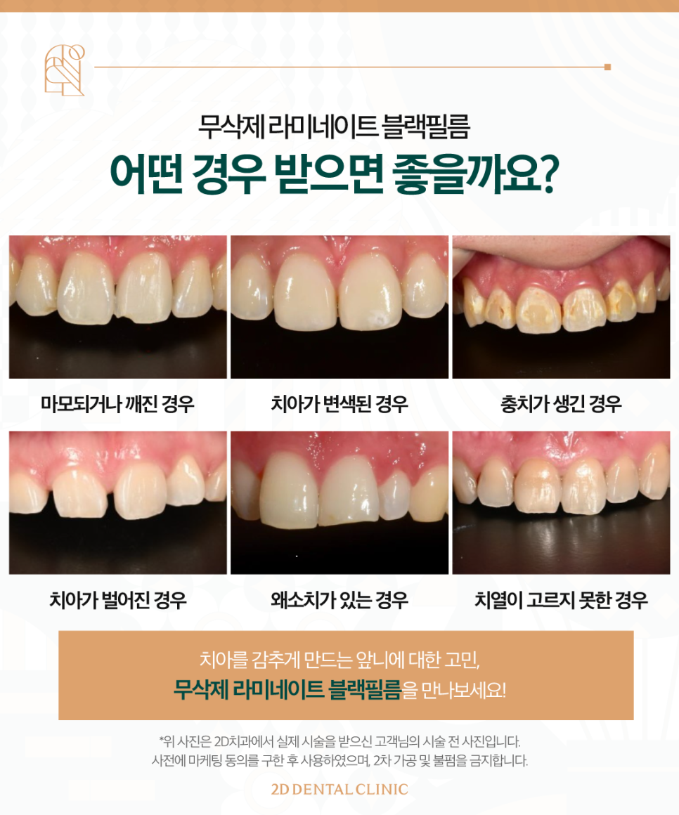 라미네이트 무삭제블랙필름 치아변색 고민, 해결은? 관련 이미지 3