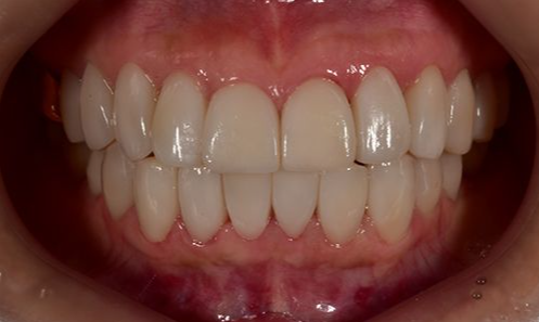 무삭제 라미네이트 교정 고민중이라면? 관련 이미지 7