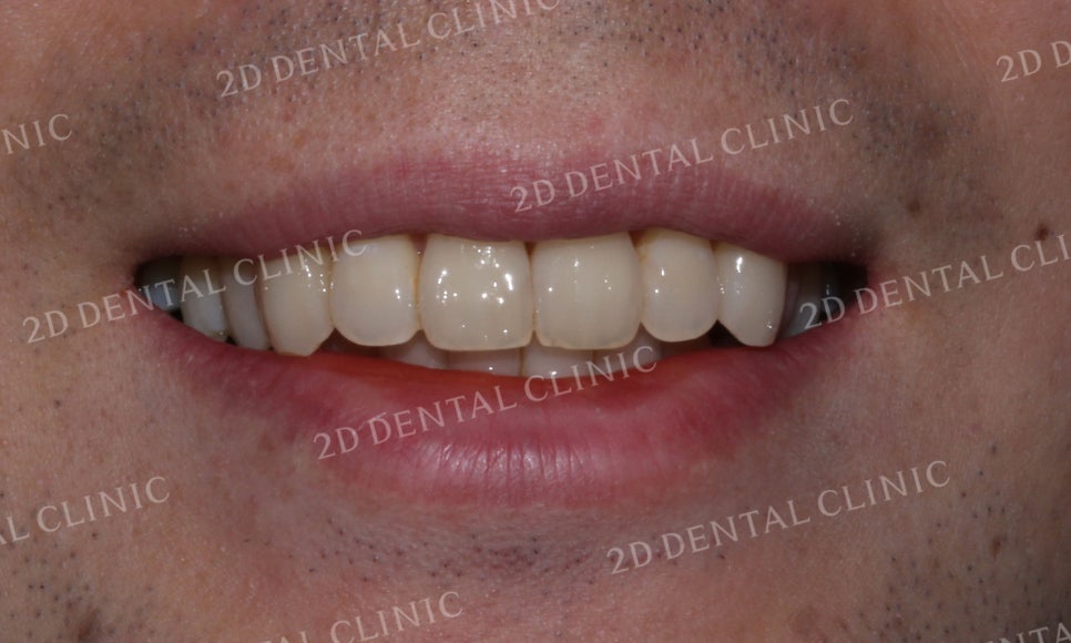 [투디교정] 부정교합 앞니교정을 투디교정으로 고르게! by.투디치과(2D치과) 관련 이미지 10