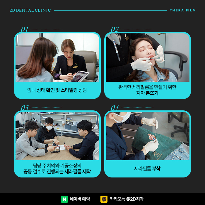 왜소치 세라필름, 원데이라미네이트로 해결하기 위해서는 강남역 치과 관련 이미지 6