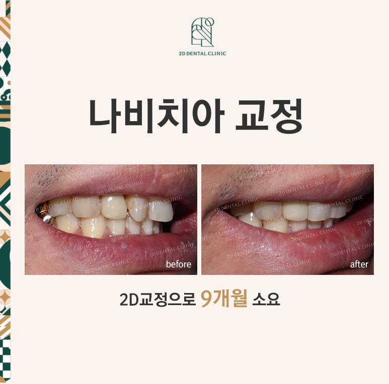 [2D교정] 나비치아교정을 2D교정 장치로 빠르게 완성하기! by.2D치과(투디치과) 관련 이미지 1