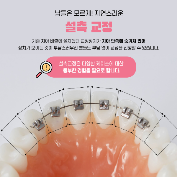 바쁜데 치아 교정 가능? 2D의 앞니교정은 가능! 관련 이미지 3