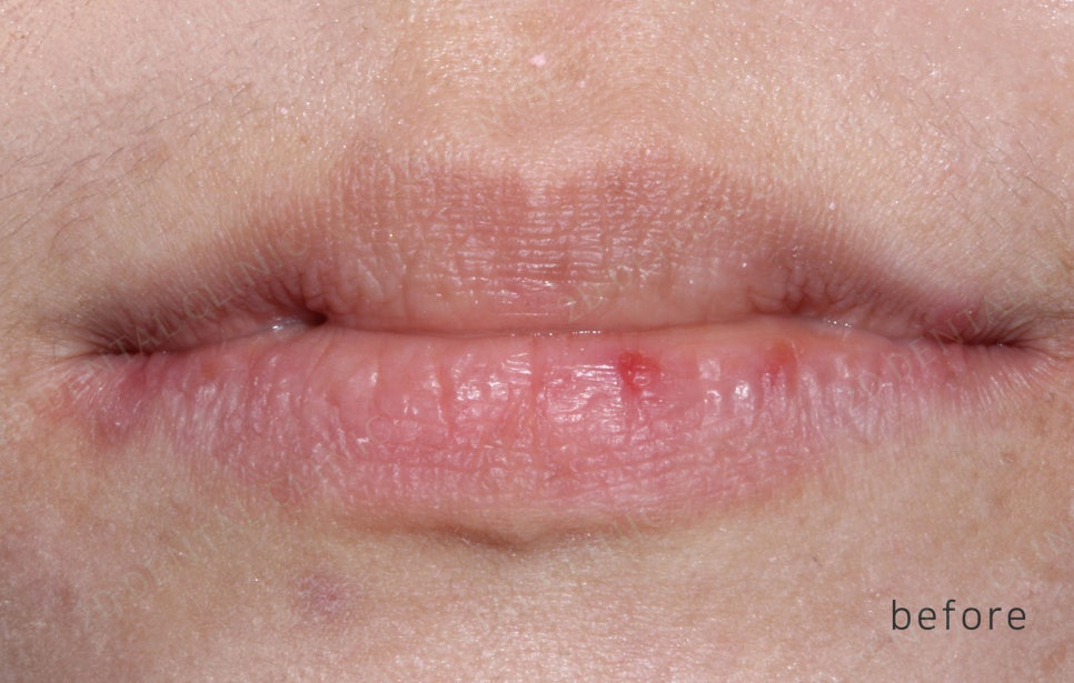 2D치과(투디치과) 교정일기ㅣ앞니덧니,반대교합 치아교정 완료!(ft.투디교정 전체교정) 관련 이미지 15