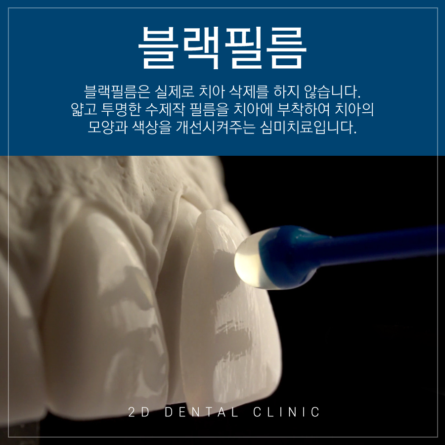 [투디치과] 블랙필름(비스포크) 치료의 다양한 사례 관련 이미지 1