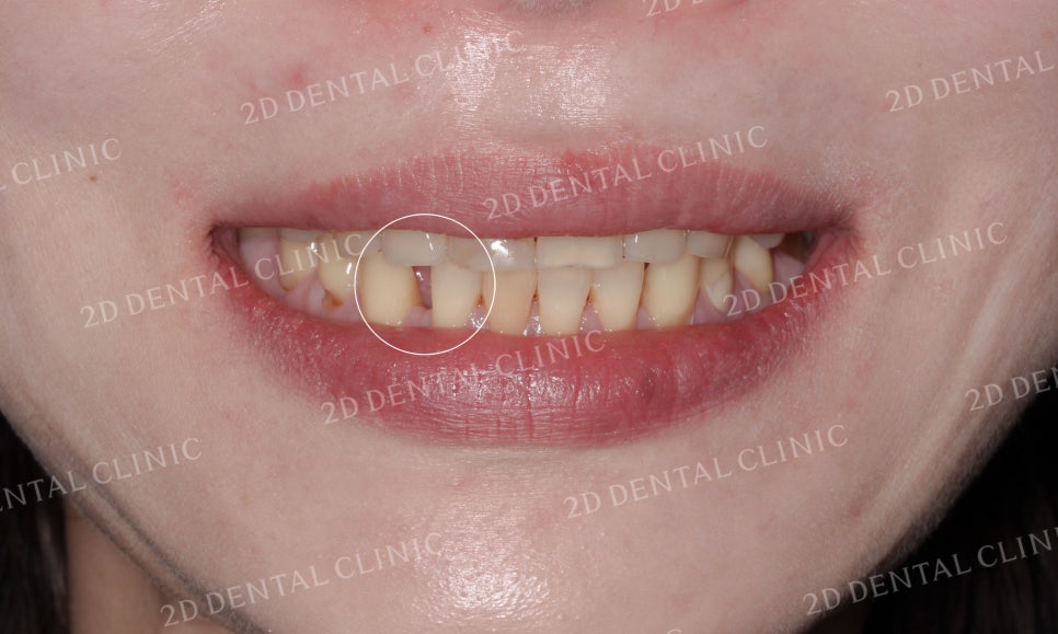 누렇고 손상된 치아를 밝고 가지런하게! by. 투디치과(2D치과)_블링스 시술후기 관련 이미지 3