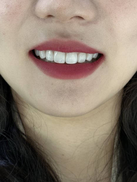 치아 심미치료 개선이 가능한 무삭제 라미네이트 블랙필름 관련 이미지 2