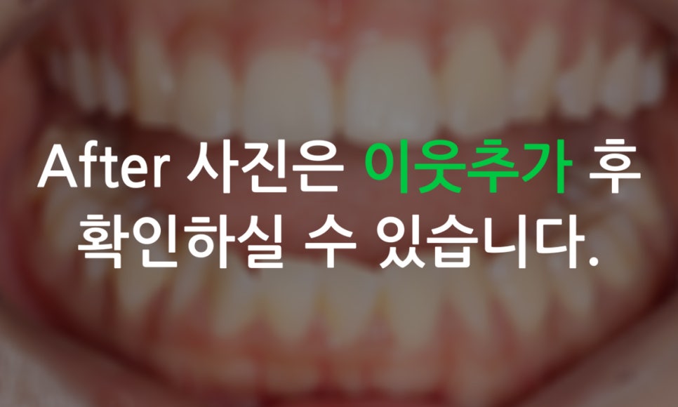 세라믹교정 앞니틀어짐 교정 사례 관련 이미지 14