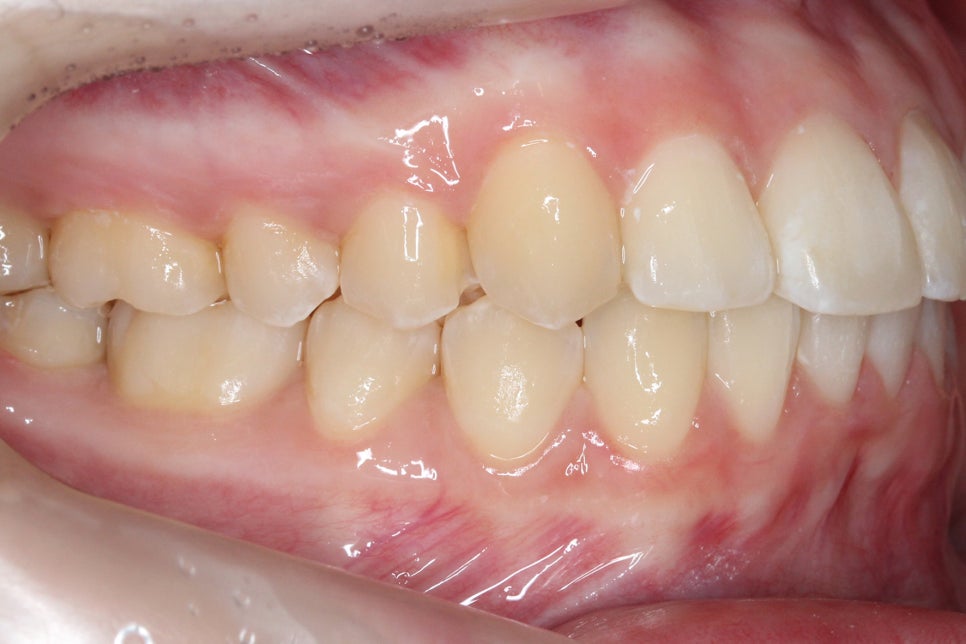 투디치과 송곳니덧니 치료 후기 관련 이미지 11