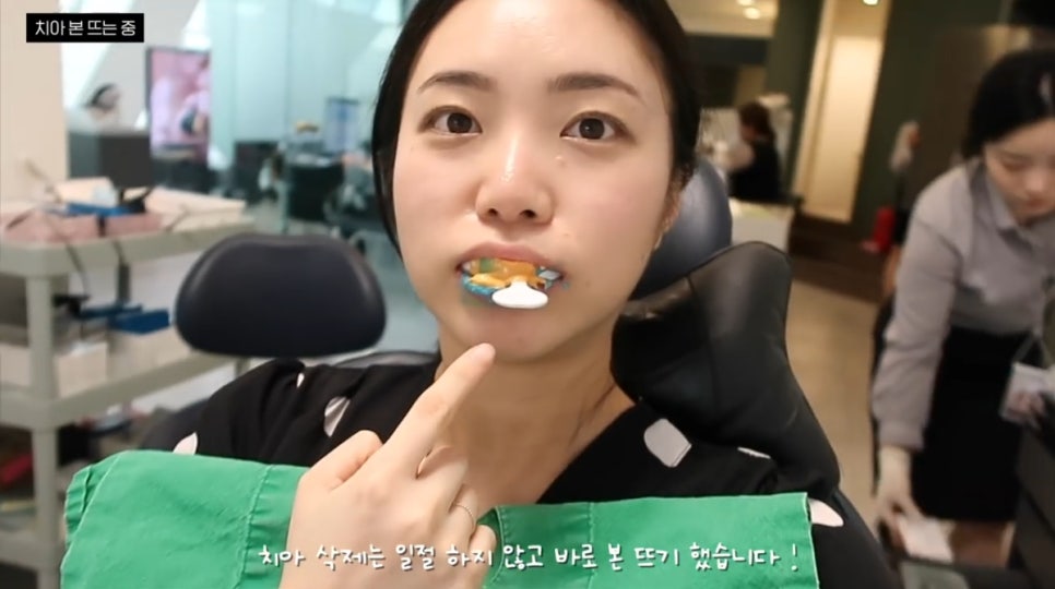 무삭제 라미네이트, 쎄라필름(TheraFilm)후기_유튜버Coco Riley님 by.2D치과(투디치과) 관련 이미지 7