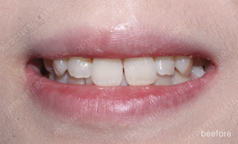 토끼이빨 치아교정 치료 사례 관련 이미지 3