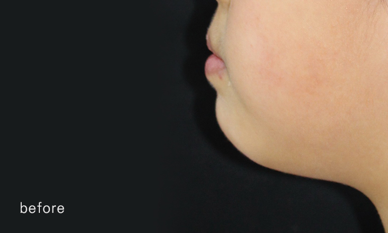 어린이 반대교합 덧니 교정으로 교정 끝! by. 투디치과(2D치과) 관련 이미지 16