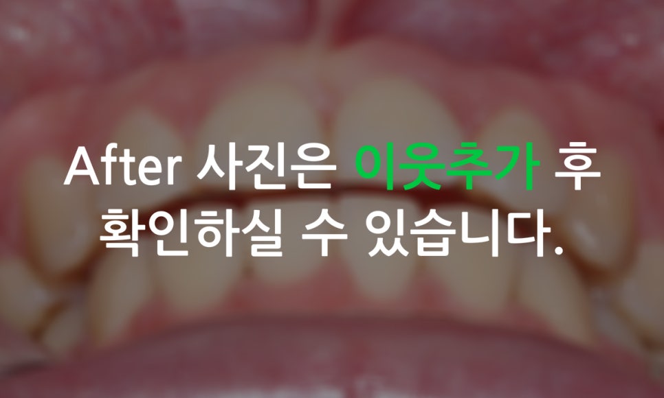 송곳니덧니 교정하는 방법! 관련 이미지 10