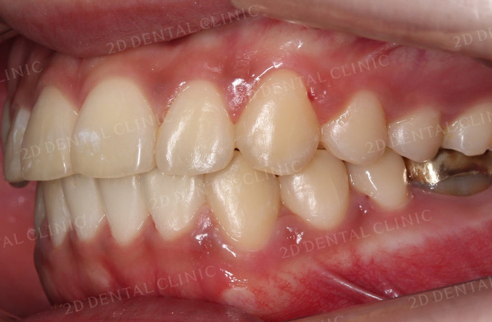 [앞니교정] 토끼앞니교정, 클리피씨 교정으로 완벽하게! by.투디치과(2D치과) 관련 이미지 15