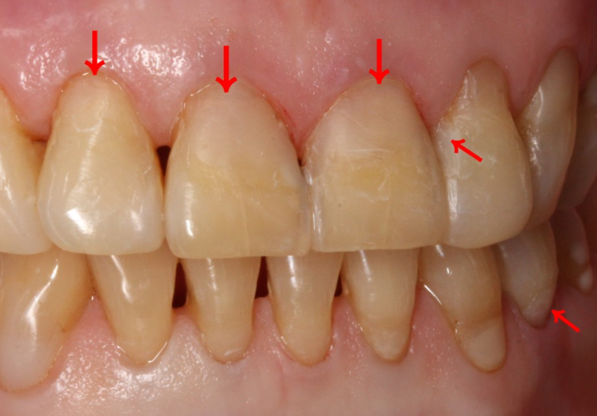 앞니치아마모증 무삭제라미네이트 블랙필름으로 치아고민해결 관련 이미지 2