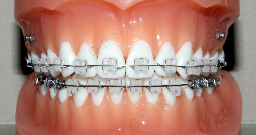 콤비교정, 합리적인 비용으로 돌출입 개선하자! 강남 투디치과 관련 이미지 3