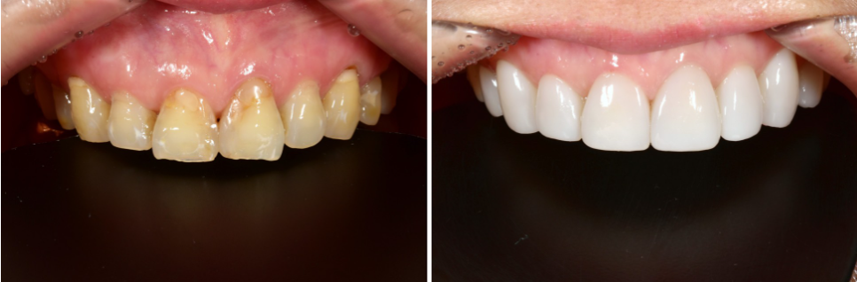 강남라미네이트치과 추천 : 진짜 무삭제, 투디치과! 관련 이미지 11