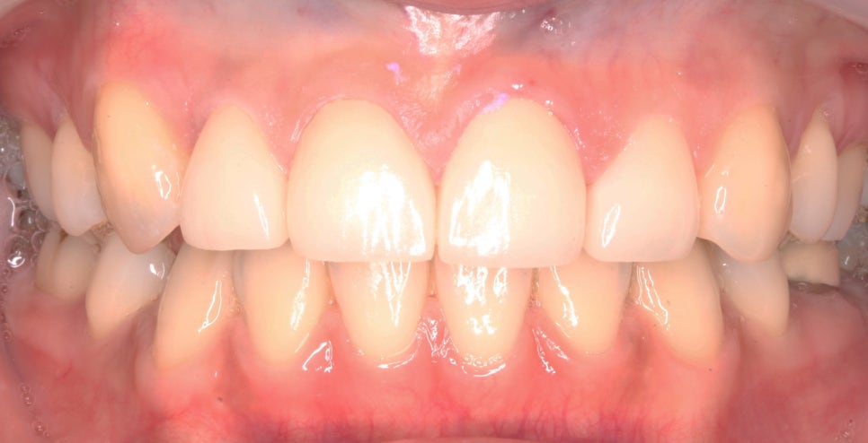 교정일기:앞니 부분 블링스(라미네이트) 심리보철 진료과정 후기 관련 이미지 4