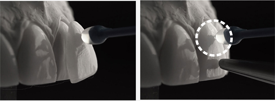 [투디치과] 블랙필름(비스포크) 치료의 다양한 사례 관련 이미지 2