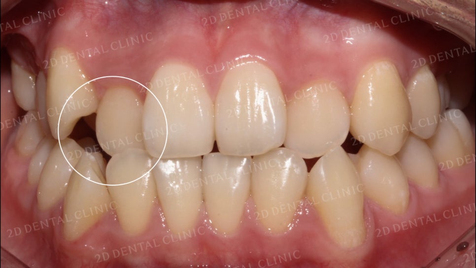 덧니치아교정, 클리피씨 전체교정으로 완벽하게! by.투디치과(2D치과) 관련 이미지 6