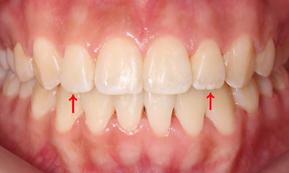 톱니모양 치아를 매끄러운 치아모양으로 개선하는 방법! (마멜론치아) 관련 이미지 6
