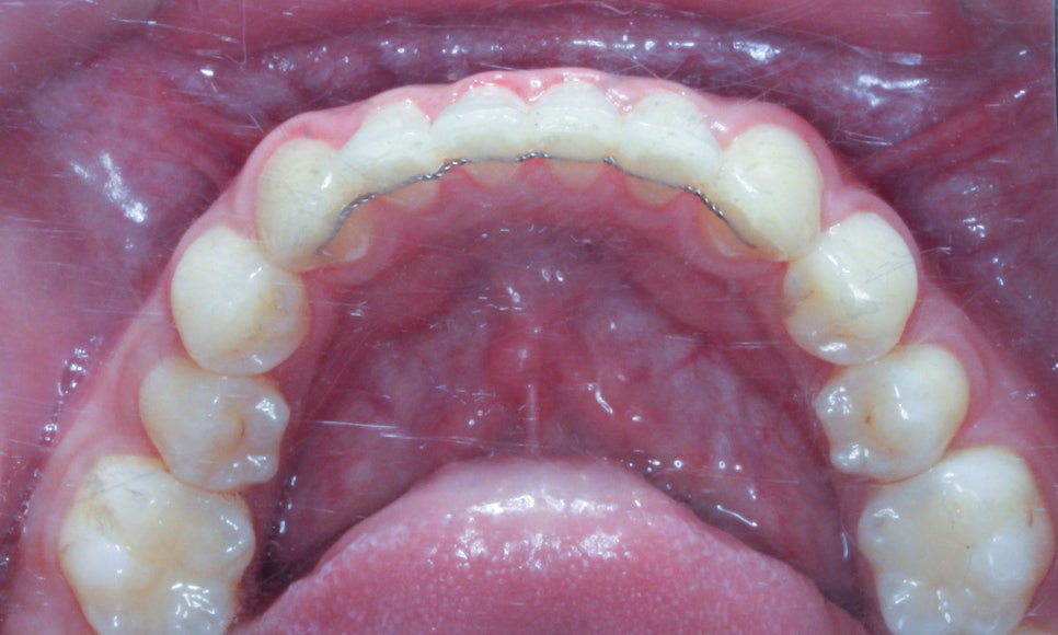 나비치아교정! 15개월만에 빠른 교정 by.투디치과(2D치과) 관련 이미지 14