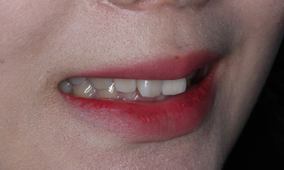 나비치아교정, 부분 치아교정으로 하고 싶다면? by.투디치과(2D치과) 관련 이미지 4