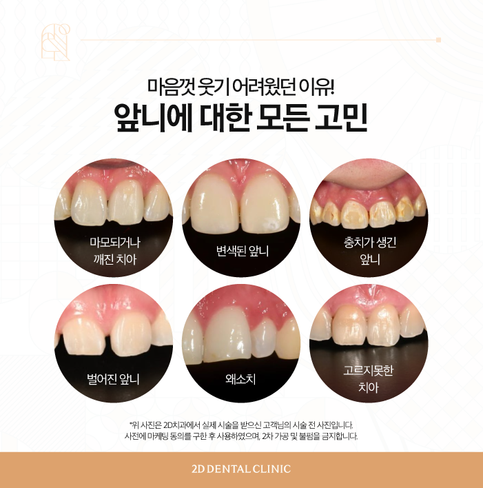 무삭제라미네이트비용 앞니 콤플렉스 극복은 블랙필름으로 관련 이미지 3